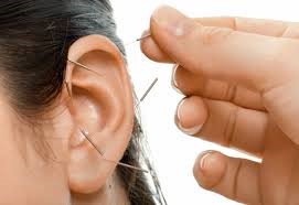 Picture of Auricular Acupuncture