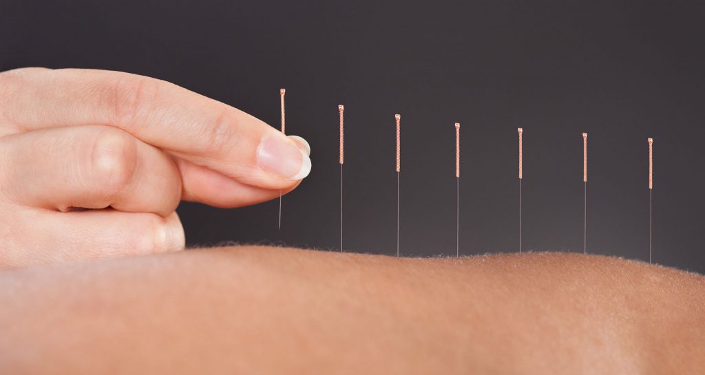 Acupuncture at Acupuncture Solutions Selby